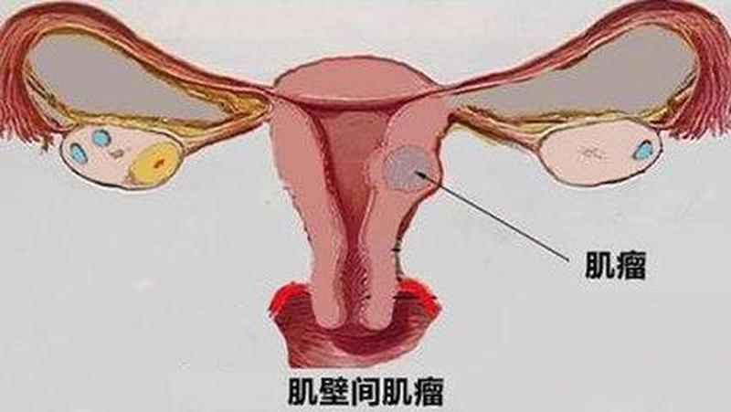 子宫粘膜下肌瘤是什么原因引起的(揭秘子宫粘膜下肌瘤——隐匿的女性健康杀手”)-第1张图片-健康养生经验分享