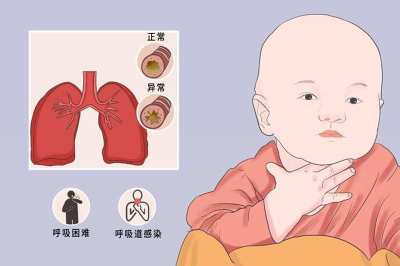 支气管闭塞_支气管闭塞：呼吸道阻塞的隐匿威胁-第1张图片-健康养生经验分享