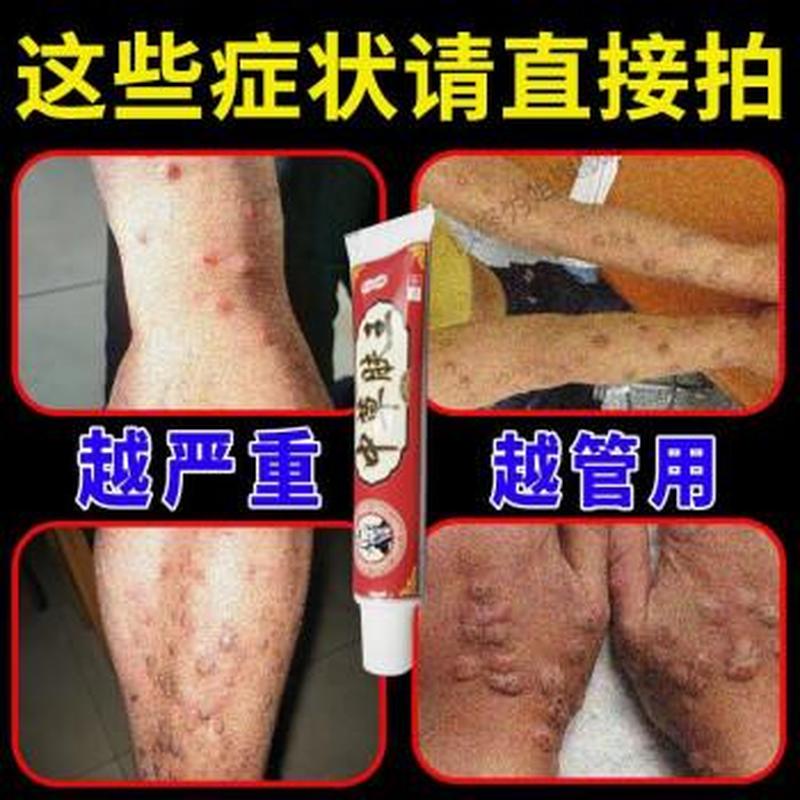 大腿胳膊痒—大腿胳膊痒用什么药-第1张图片-健康养生经验分享