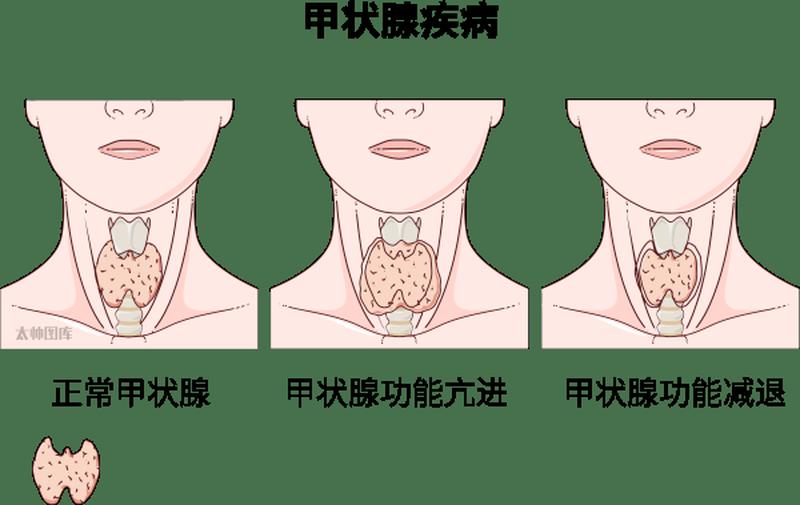 游离三碘甲状腺原氨酸(游离三碘甲状腺异常与甲状腺功能评估)-第1张图片-健康养生经验分享