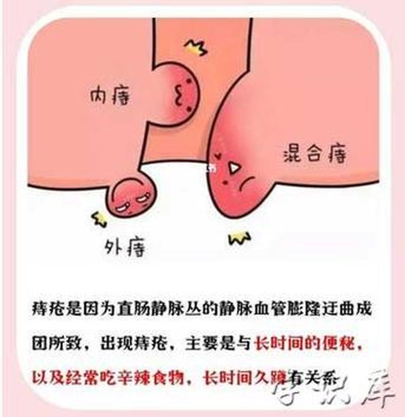 痔疮肉球怎么消除_ *** 痔疮肉球怎么消除-第1张图片-健康养生经验分享